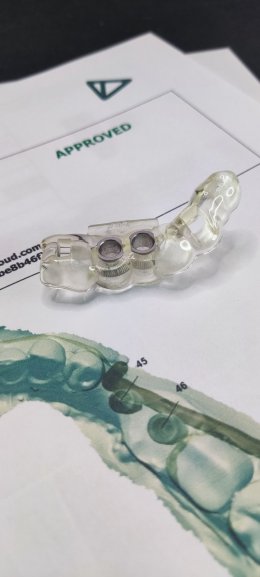 Straumann Implant