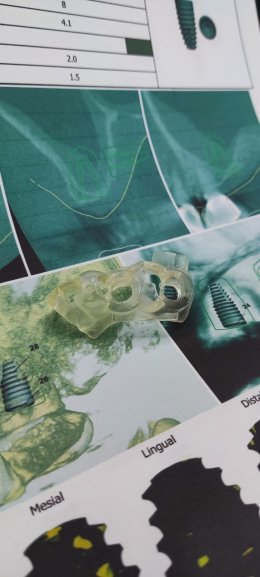 Straumann Implant
