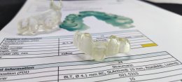 Straumann Implant