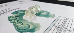 Straumann Implant