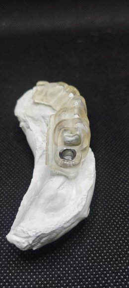 Dentium implant