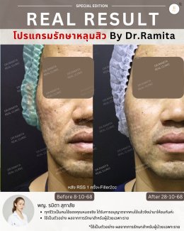 รักษาหลุมสิวราคา? ราคาสามารถบอกอะไรเราได้บ้าง?