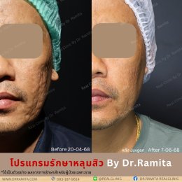 รักษาหลุมสิว,ตัดพังผืด,รักษาหลุมสิว, วิธีรักษาหลุมสิว, Subcision, เติมฟิลเลอร์, Real Scar Synergy, รักษาหลุมสิวที่ไหนดี,Juvgen,acnescarsurgery,acnescarrevision,รักษาหลุมสิวให้ตื้น,เลเซอร์หลุมสิว, รักษาหลุมสิวที่ดีที่สุด,รักษาหลุมสิวให้หายขาด,หลุมสิว,realc