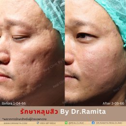 "รักษาหลุมสิว" ที่ Real Clinic By Dr. Ramita พิเศษอย่างไร 
