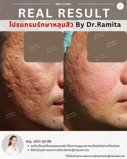 รักษาหลุมสิวราคา? ราคาสามารถบอกอะไรเราได้บ้าง?