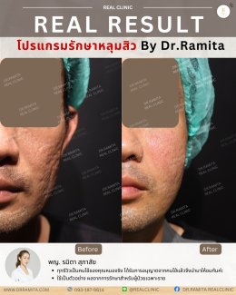 รักษาหลุมสิวราคา? ราคาสามารถบอกอะไรเราได้บ้าง?