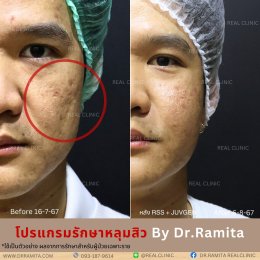 รักษาหลุมสิว,ตัดพังผืด,รักษาหลุมสิว, วิธีรักษาหลุมสิว, Subcision, เติมฟิลเลอร์, Real Scar Synergy, รักษาหลุมสิวที่ไหนดี,Juvgen,acnescarsurgery,acnescarrevision,รักษาหลุมสิวให้ตื้น,เลเซอร์หลุมสิว, รักษาหลุมสิวที่ดีที่สุด,รักษาหลุมสิวให้หายขาด,หลุมสิว,realc
