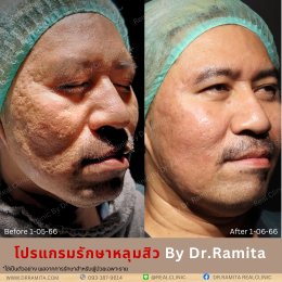 รักษาหลุมสิว,ตัดพังผืด,รักษาหลุมสิว, วิธีรักษาหลุมสิว, Fractional Laser, Microneedling, Subcision, เติมฟิลเลอร์, Real Scar Synergy, Juvgen,acnescarsurgery,acnescarrevision,รักษาหลุมสิวให้ตื้น,เลเซอร์หลุมสิว, รักษาหลุมสิวที่ดีที่สุด,รักษาหลุมสิวให้หายขาด,ห