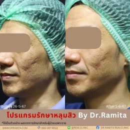 juvgen drjin ดร.จิน หลุมสิวเกาหลี รักษาหลุมสิว ศัลยกรรมหลุมสิว real scar synergy dr ramita 