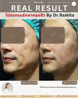 รักษาหลุมสิวราคา? ราคาสามารถบอกอะไรเราได้บ้าง?