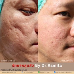 "รักษาหลุมสิว" ที่ Real Clinic By Dr. Ramita พิเศษอย่างไร 