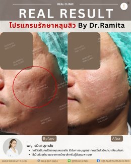 รักษาหลุมสิวราคา? ราคาสามารถบอกอะไรเราได้บ้าง?