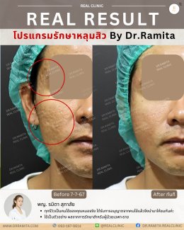 รักษาหลุมสิวราคา? ราคาสามารถบอกอะไรเราได้บ้าง?