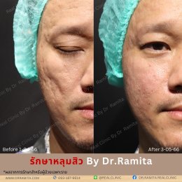 "รักษาหลุมสิว" ที่ Real Clinic By Dr. Ramita พิเศษอย่างไร 