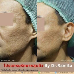 "JUVGEN" นวตกรรมรักษาหลุมสิวโดย ดร.จิน พร้อมให้บริการที่ไทยแล้ววันนี้ ที่ RealClinic 