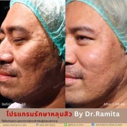 "JUVGEN" นวตกรรมรักษาหลุมสิวโดย ดร.จิน พร้อมให้บริการที่ไทยแล้ววันนี้ ที่ RealClinic 