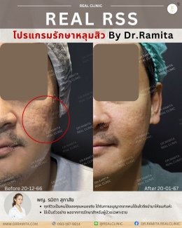 รักษาหลุมสิวราคา? ราคาสามารถบอกอะไรเราได้บ้าง?