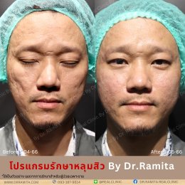 "JUVGEN" นวตกรรมรักษาหลุมสิวโดย ดร.จิน พร้อมให้บริการที่ไทยแล้ววันนี้ ที่ RealClinic 