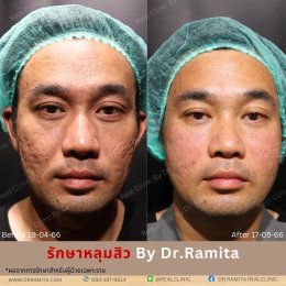 "รักษาหลุมสิว" ที่ Real Clinic By Dr. Ramita พิเศษอย่างไร 