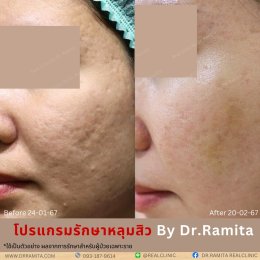 juvgen drjin ดร.จิน หลุมสิวเกาหลี รักษาหลุมสิว ศัลยกรรมหลุมสิว real scar synergy dr ramita 