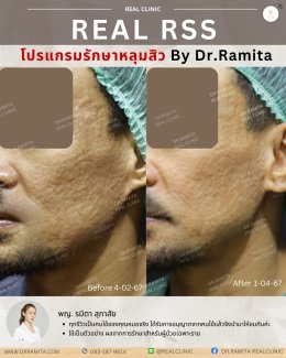 รักษาหลุมสิวราคา? ราคาสามารถบอกอะไรเราได้บ้าง?