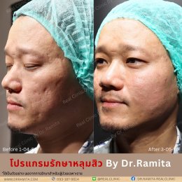 "JUVGEN" นวตกรรมรักษาหลุมสิวโดย ดร.จิน พร้อมให้บริการที่ไทยแล้ววันนี้ ที่ RealClinic 