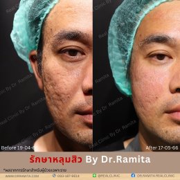 "รักษาหลุมสิว" ที่ Real Clinic By Dr. Ramita พิเศษอย่างไร 