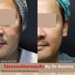 "JUVGEN" นวตกรรมรักษาหลุมสิวโดย ดร.จิน พร้อมให้บริการที่ไทยแล้ววันนี้ ที่ RealClinic 