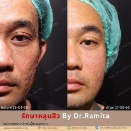 "รักษาหลุมสิว" ที่ Real Clinic By Dr. Ramita พิเศษอย่างไร 