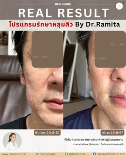 ทำ JUVGEN กับคุณหมอ รมิตา พิเศษอย่างไร?  ถ่ายทอดโดยตรงจาก ดร.จิน 