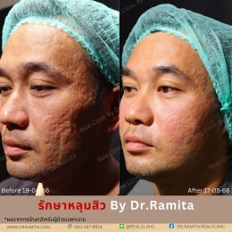 "รักษาหลุมสิว" ที่ Real Clinic By Dr. Ramita พิเศษอย่างไร 