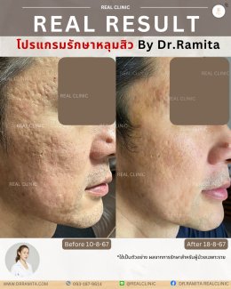 ทำ JUVGEN กับคุณหมอ รมิตา พิเศษอย่างไร?  ถ่ายทอดโดยตรงจาก ดร.จิน 