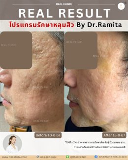 ทำ JUVGEN กับคุณหมอ รมิตา พิเศษอย่างไร?  ถ่ายทอดโดยตรงจาก ดร.จิน 