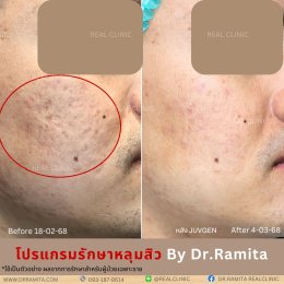 "ฟิลเลอร์หลุมสิว" คืออะไร "ฉีดหลุมสิวฟิลเลอร์" ตัวไหนดี? คุ้มค่าไหมที่จะฉีดฟิลเลอร์หลุมสิว!? 
