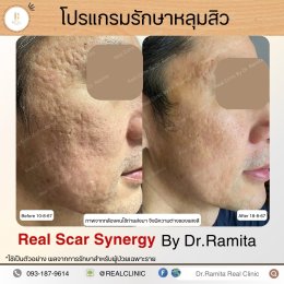 รักษาหลุมสิว,ตัดพังผืด,รักษาหลุมสิว, วิธีรักษาหลุมสิว, Fractional Laser, Microneedling, Subcision, เติมฟิลเลอร์, Real Scar Synergy, Juvgen,acnescarsurgery,acnescarrevision,รักษาหลุมสิวให้ตื้น,เลเซอร์หลุมสิว, รักษาหลุมสิวที่ดีที่สุด,รักษาหลุมสิวให้หายขาด,ห