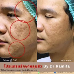 juvgen drjin ดร.จิน หลุมสิวเกาหลี รักษาหลุมสิว ศัลยกรรมหลุมสิว real scar synergy dr ramita  รีวิวหลุมสิว