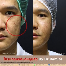 juvgen drjin ดร.จิน หลุมสิวเกาหลี รักษาหลุมสิว ศัลยกรรมหลุมสิว real scar synergy dr ramita  รีวิวหลุมสิว