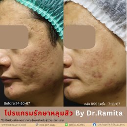 juvgen drjin ดร.จิน หลุมสิวเกาหลี รักษาหลุมสิว ศัลยกรรมหลุมสิว real scar synergy dr ramita 