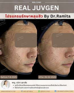 รักษาหลุมสิวราคา? ราคาสามารถบอกอะไรเราได้บ้าง?