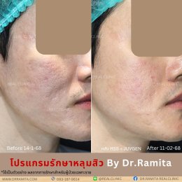 ภาพรีวิวรักษาหลุมสิว