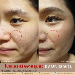 "JUVGEN" นวตกรรมรักษาหลุมสิวโดย ดร.จิน พร้อมให้บริการที่ไทยแล้ววันนี้ ที่ RealClinic 