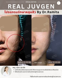 รักษาหลุมสิวราคา? ราคาสามารถบอกอะไรเราได้บ้าง?