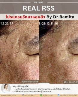 รักษาหลุมสิวราคา? ราคาสามารถบอกอะไรเราได้บ้าง?