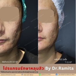 juvgen drjin ดร.จิน หลุมสิวเกาหลี รักษาหลุมสิว ศัลยกรรมหลุมสิว real scar synergy dr ramita  รีวิวหลุมสิว