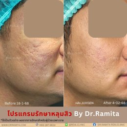 "ฟิลเลอร์หลุมสิว" คืออะไร "ฉีดหลุมสิวฟิลเลอร์" ตัวไหนดี? คุ้มค่าไหมที่จะฉีดฟิลเลอร์หลุมสิว!? 