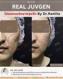 รักษาหลุมสิวราคา? ราคาสามารถบอกอะไรเราได้บ้าง?