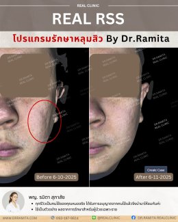 รักษาหลุมสิวราคา? ราคาสามารถบอกอะไรเราได้บ้าง?