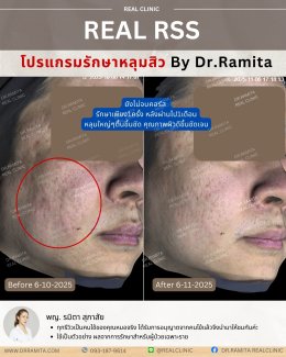 รักษาหลุมสิวราคา? ราคาสามารถบอกอะไรเราได้บ้าง?