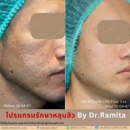 "JUVGEN" นวตกรรมรักษาหลุมสิวโดย ดร.จิน พร้อมให้บริการที่ไทยแล้ววันนี้ ที่ RealClinic 