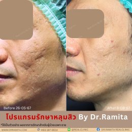 juvgen drjin ดร.จิน หลุมสิวเกาหลี รักษาหลุมสิว ศัลยกรรมหลุมสิว real scar synergy dr ramita 